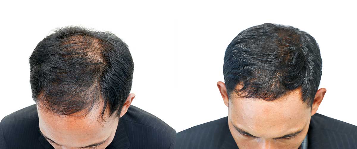 Hair Loss - Southwest Dermatology Specialists